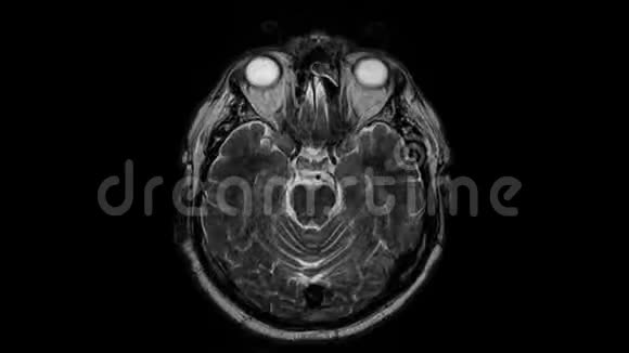 脑MRI头部扫描和肿瘤检测诊断医疗工具视频的预览图
