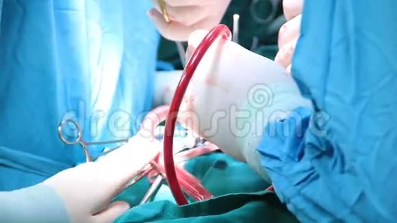 对病人进行手术的外科医生小组视频的预览图