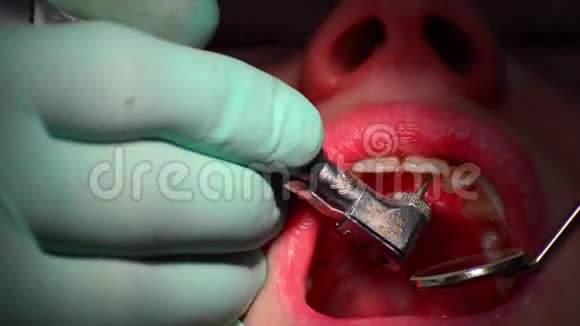 牙钻是牙齿上的龋齿视频的预览图