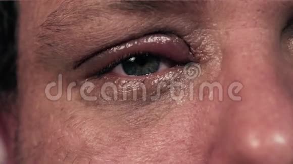 眼睛受感染的人视频的预览图