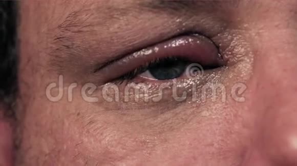 眼睛受感染的人视频的预览图