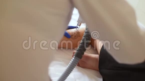 美容师用激光去除了一个年轻漂亮女孩腿上的纹身视频的预览图