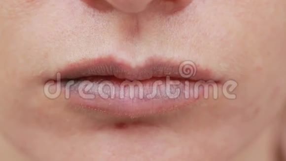 女性嘴唇有瘀伤特写镜头透明质酸的作用隆唇手术视频的预览图