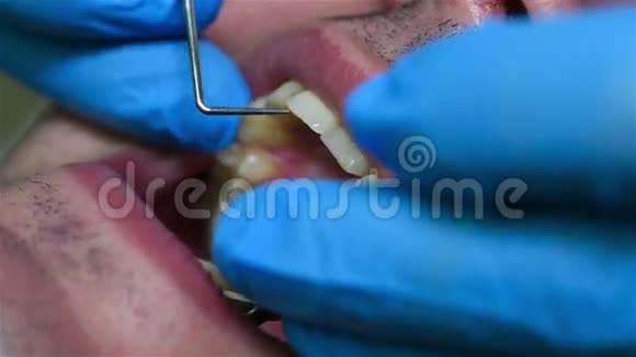 牙医对牙齿的印象视频的预览图