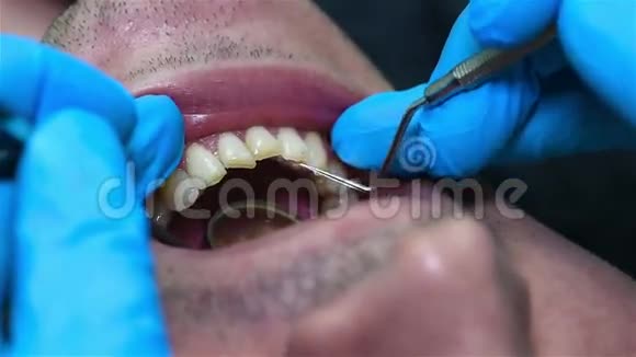 牙医检查病人的嘴视频的预览图