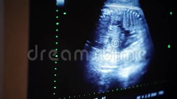 孕妇产科超声胎儿视频的预览图