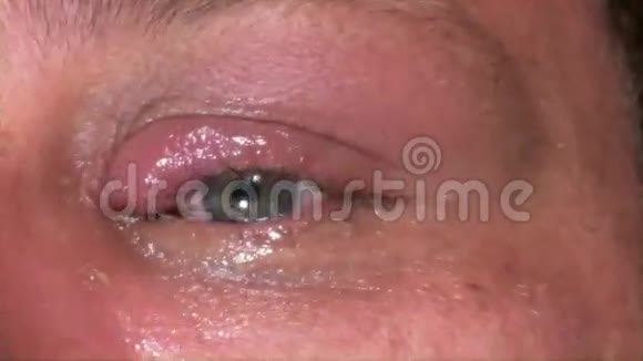 感染眼药水的人视频的预览图