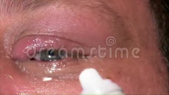 感染眼药水的人视频的预览图