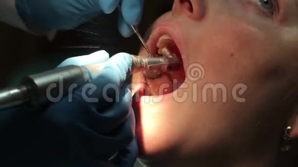 牙医漂白病人的牙齿视频的预览图