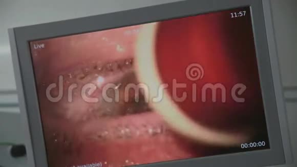 医生屏幕上的眼科手术白内障摘除手术快关门视频的预览图