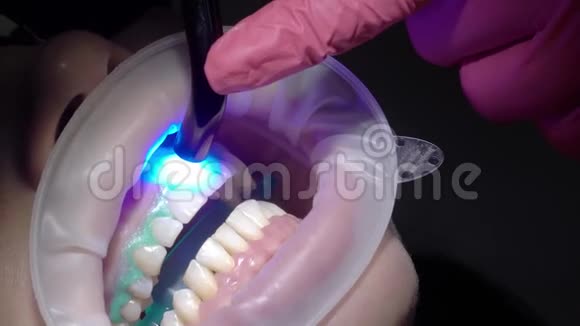 牙科医生为女性病人做牙齿美白视频的预览图