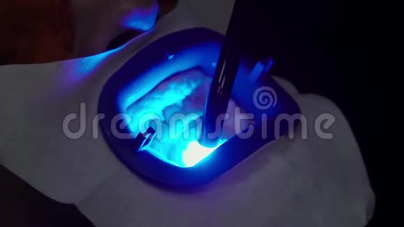 紫外线灯患者牙齿美白视频的预览图