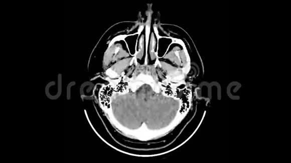 头骨的计算机断层扫描脑检查视频的预览图