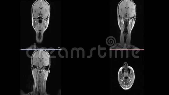 脑硬化微中风白斑的磁共振成像颈部视频的预览图