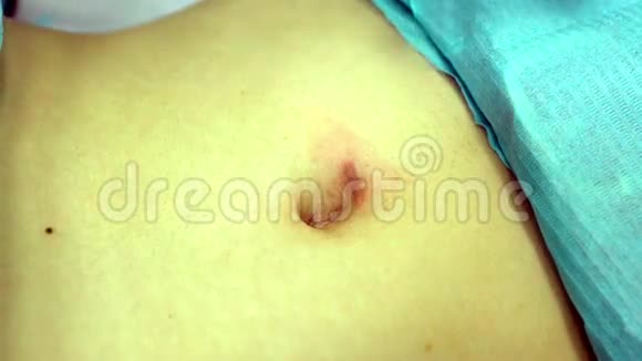 激光除胃术的疤痕视频的预览图