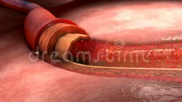 人体内的血流量视频的预览图