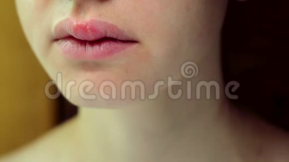 一个年轻美丽的女人上唇的单纯疱疹病毒视频的预览图