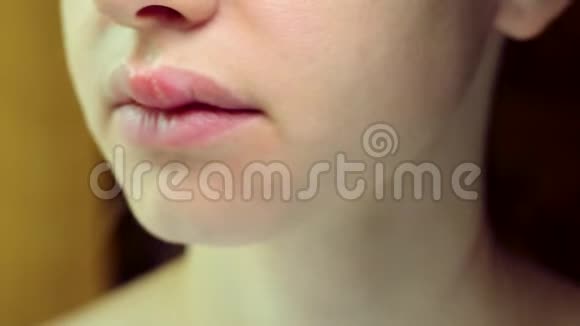 一个年轻美丽的女人上唇的单纯疱疹病毒视频的预览图