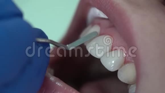 牙科医生给牙床病人做牙齿矫正视频的预览图