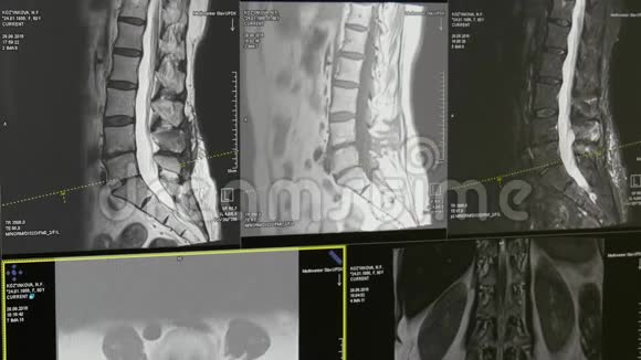 脊髓和脊柱断层扫描MRI扫描视频的预览图