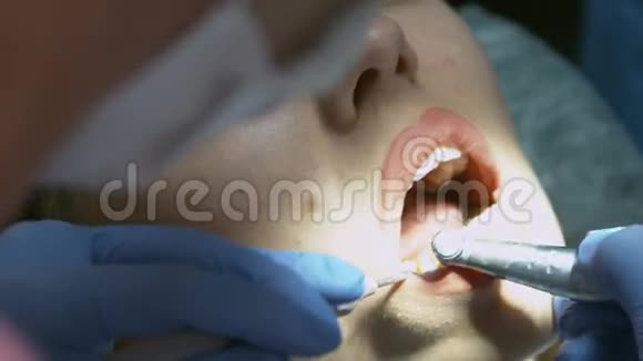 牙科医生用牙垢和牙石清洁牙齿的方法视频的预览图