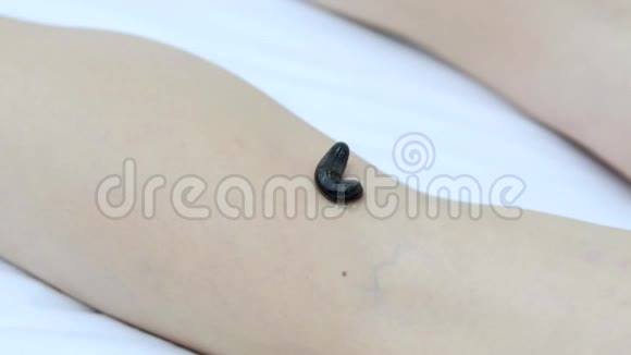 临床用水蛭疗法女性皮肤蛭视频的预览图