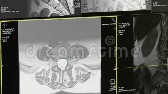 脊髓和脊柱断层扫描MRI扫描视频的预览图