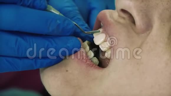 牙医把牙贴面病人视频的预览图