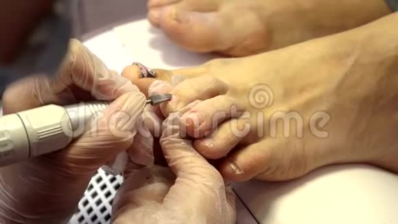 内冠脚趾甲的治疗你的指甲医生是足科医生硬件修脚儿科视频的预览图
