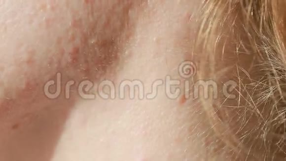 球形囊性痤疮在皮肤上特写镜头皮肤科的概念视频的预览图