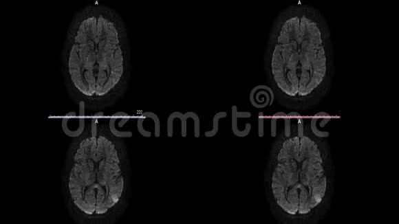 磁共振成像硬化脑微中风白斑视频的预览图
