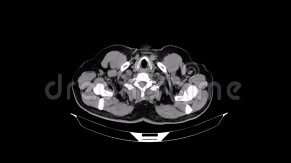 血管胸腔基底期视频的预览图