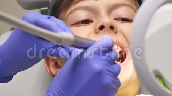 牙科诊所牙齿钻孔治疗过程中的儿童特写视频的预览图