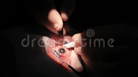 手拿医生做眼科手术的工具视频的预览图