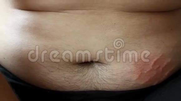 把男性腹部贴紧腹部肿胀有拉伸痕迹视频的预览图