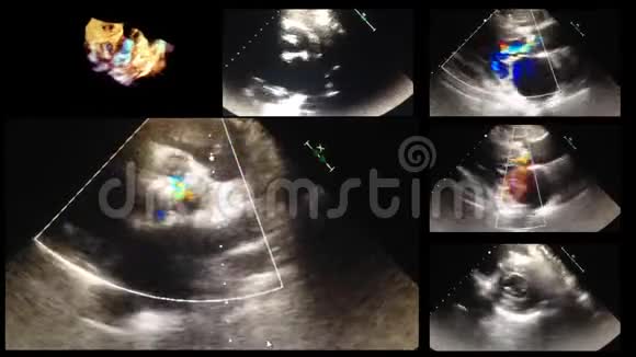 心脏超声超声检查视频的预览图