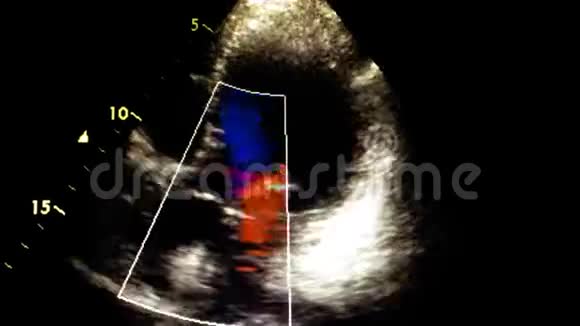 心脏超声超声检查视频的预览图