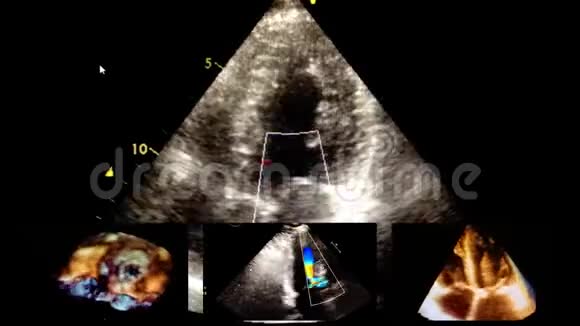 超声三维心脏检查视频的预览图