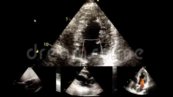 心脏超声超声检查视频的预览图