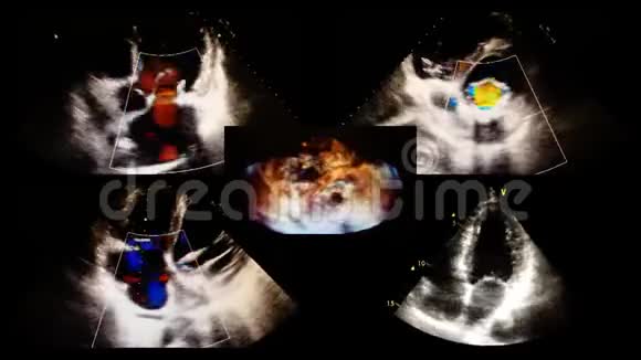 超声三维心脏检查视频的预览图
