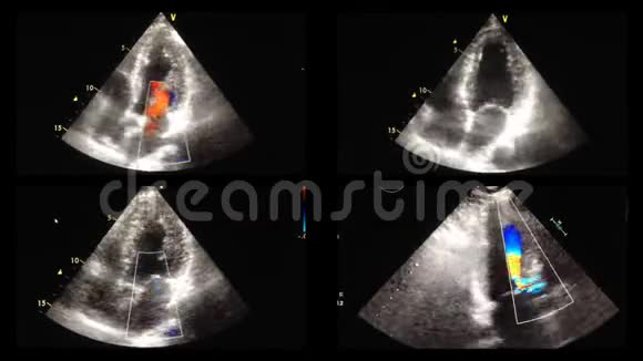 心脏超声超声检查视频的预览图