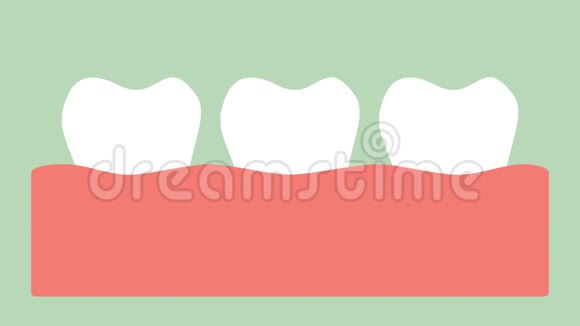 牙龈炎或牙龈病牙周病前牙龈炎视频的预览图