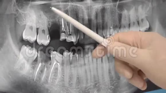 牙科诊所牙医检查病人牙齿全景快照视频的预览图