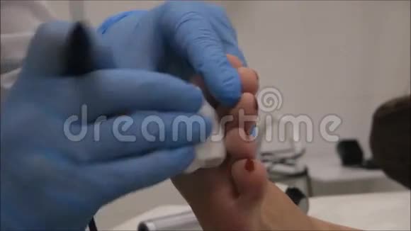 皮肤学家外科医生用电凝器切除疣第910步视频的预览图