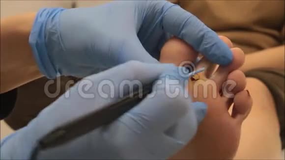皮肤学家外科医生用电凝器切除疣步骤210视频的预览图