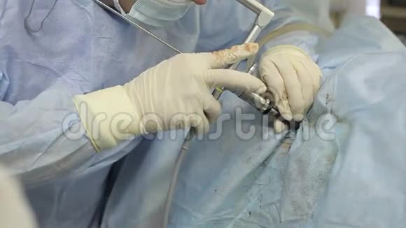 切除肾结石的手术碎石摄影特写视频的预览图