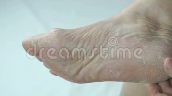 女性足部指甲真菌感染视频的预览图