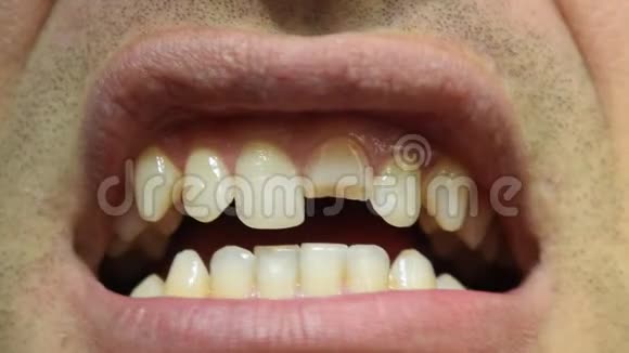 坏牙人口上切牙折断视频的预览图