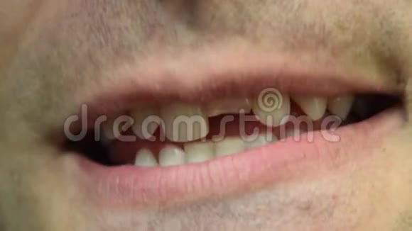 坏牙人口上切牙折断视频的预览图