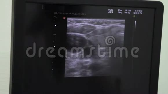 超声波诊断超声波监视器超声波互动回声图图片监视器视频的预览图